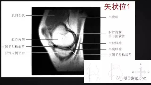 【PPT】膝关节解剖和半月板损伤影像解读
