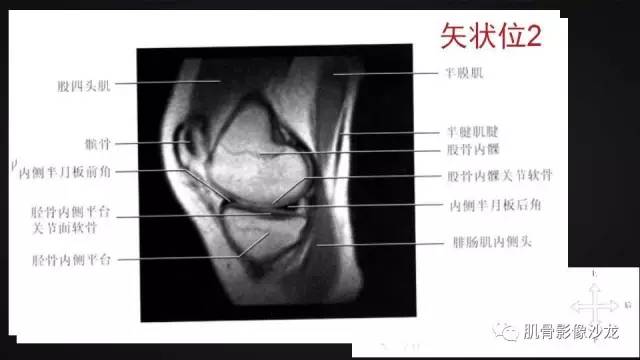 【PPT】膝关节解剖和半月板损伤影像解读