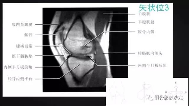 【PPT】膝关节解剖和半月板损伤影像解读