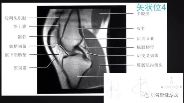【PPT】膝关节解剖和半月板损伤影像解读