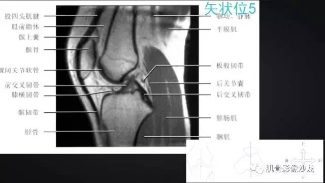 【PPT】膝关节解剖和半月板损伤影像解读