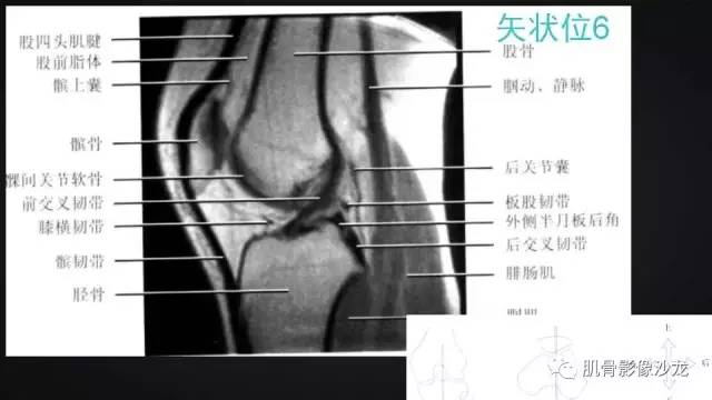 【PPT】膝关节解剖和半月板损伤影像解读