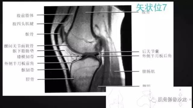 【PPT】膝关节解剖和半月板损伤影像解读