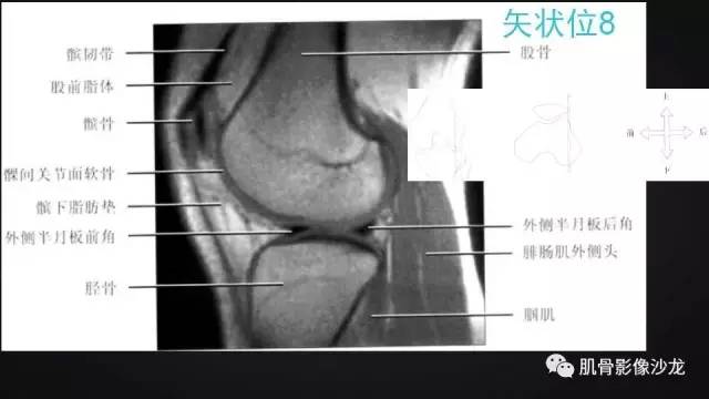 【PPT】膝关节解剖和半月板损伤影像解读