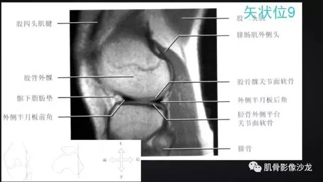 【PPT】膝关节解剖和半月板损伤影像解读
