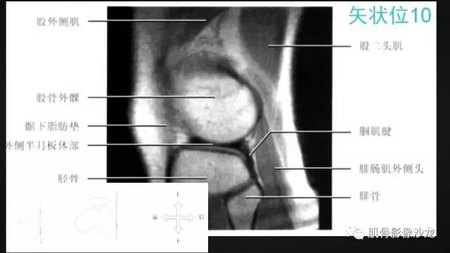 【PPT】膝关节解剖和半月板损伤影像解读