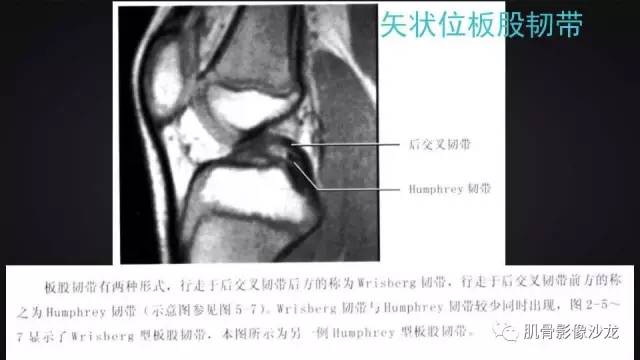 【PPT】膝关节解剖和半月板损伤影像解读
