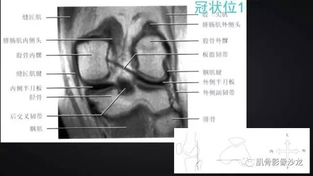 【PPT】膝关节解剖和半月板损伤影像解读