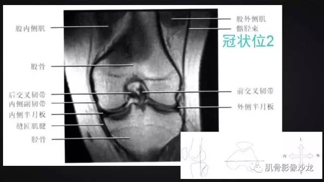 【PPT】膝关节解剖和半月板损伤影像解读