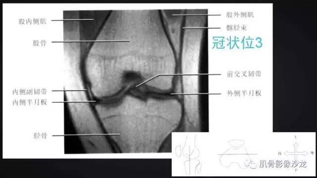 【PPT】膝关节解剖和半月板损伤影像解读