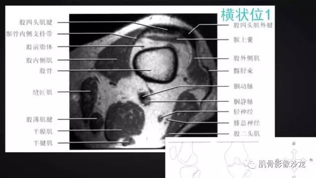 【PPT】膝关节解剖和半月板损伤影像解读