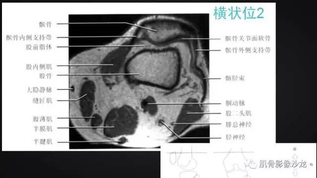 【PPT】膝关节解剖和半月板损伤影像解读