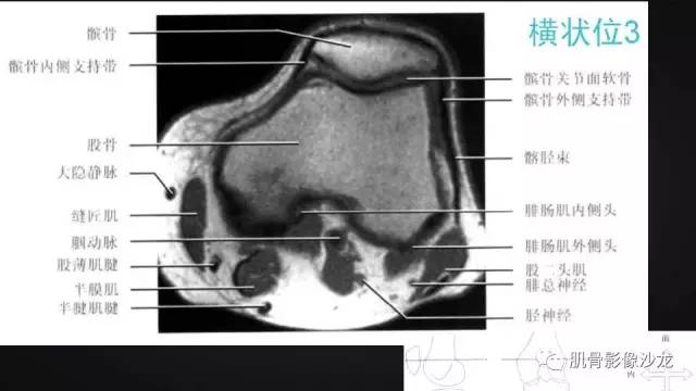 【PPT】膝关节解剖和半月板损伤影像解读