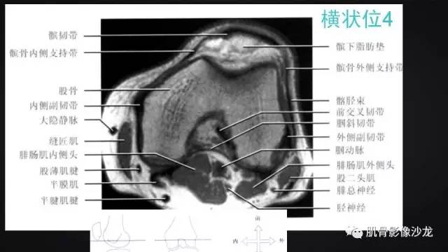 【PPT】膝关节解剖和半月板损伤影像解读