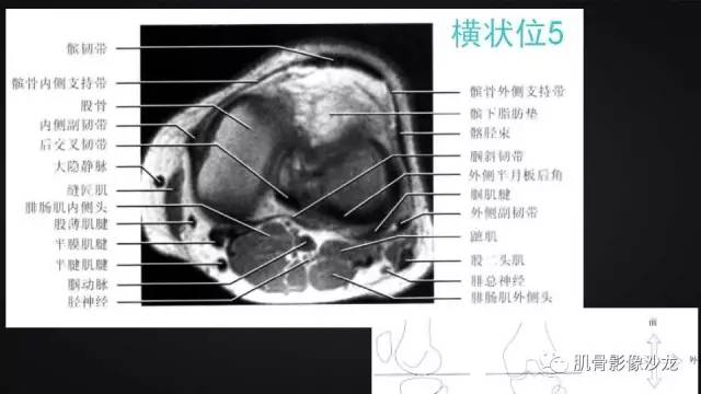 【PPT】膝关节解剖和半月板损伤影像解读