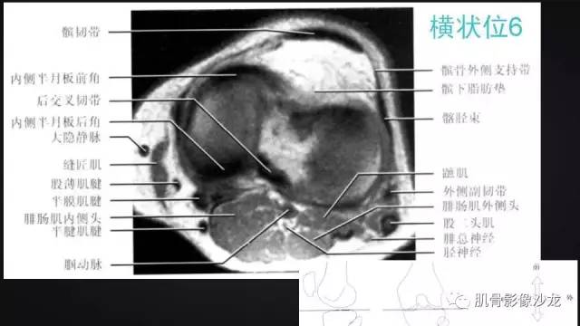 【PPT】膝关节解剖和半月板损伤影像解读