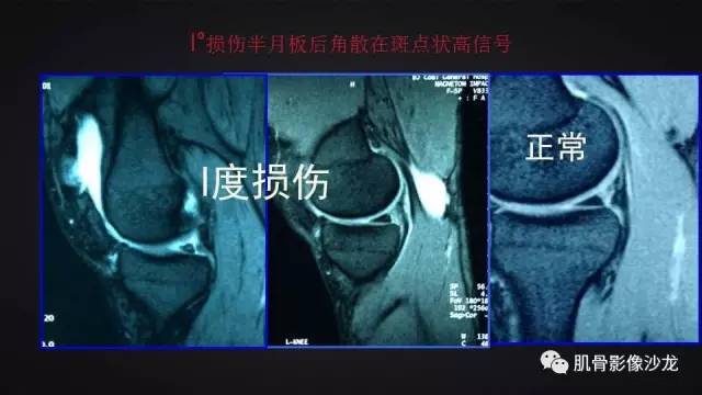 【PPT】膝关节解剖和半月板损伤影像解读
