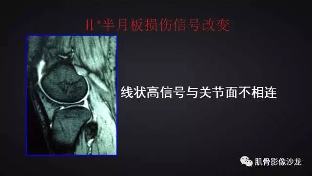 【PPT】膝关节解剖和半月板损伤影像解读