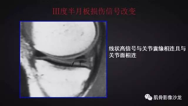【PPT】膝关节解剖和半月板损伤影像解读
