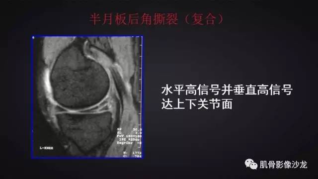 【PPT】膝关节解剖和半月板损伤影像解读