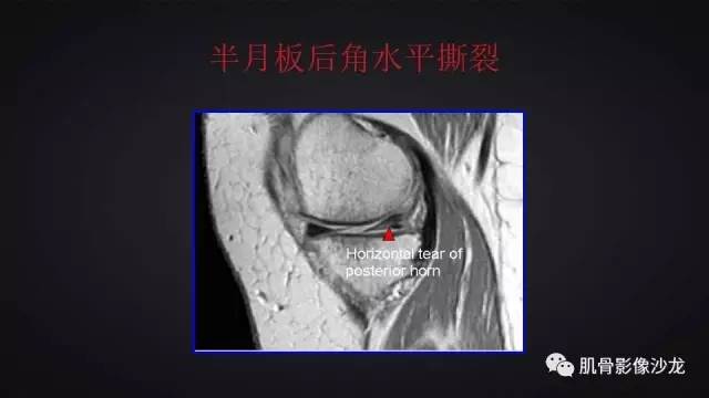 【PPT】膝关节解剖和半月板损伤影像解读