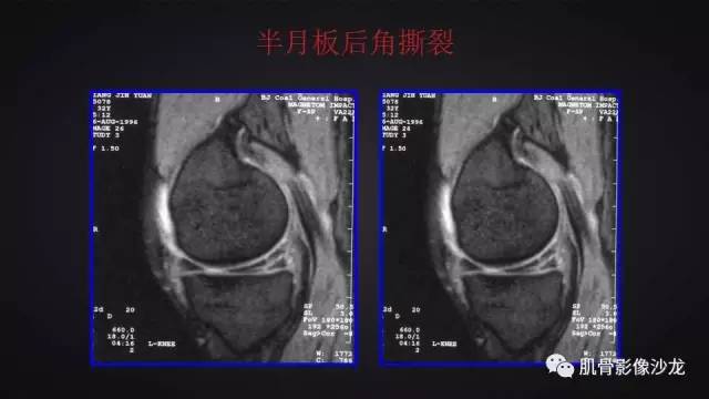 【PPT】膝关节解剖和半月板损伤影像解读