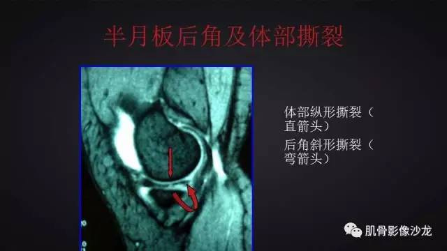 【PPT】膝关节解剖和半月板损伤影像解读