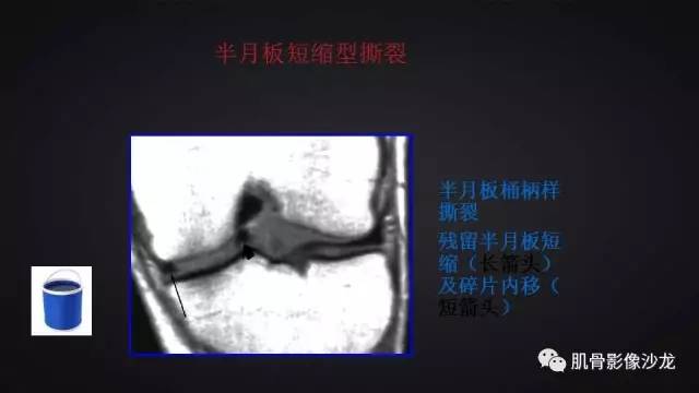 【PPT】膝关节解剖和半月板损伤影像解读