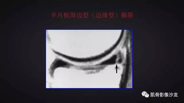 【PPT】膝关节解剖和半月板损伤影像解读