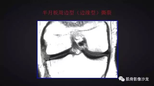【PPT】膝关节解剖和半月板损伤影像解读