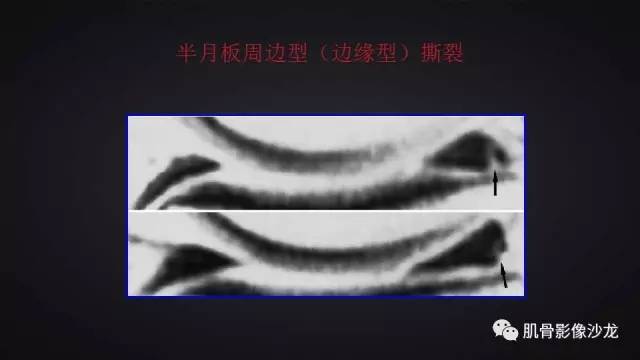 【PPT】膝关节解剖和半月板损伤影像解读