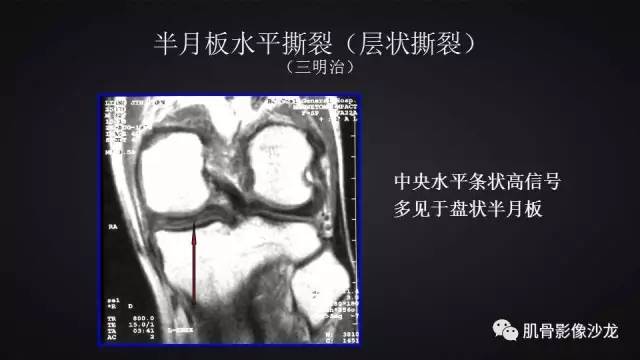 【PPT】膝关节解剖和半月板损伤影像解读