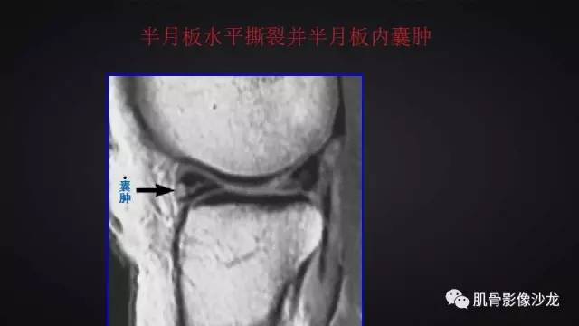 【PPT】膝关节解剖和半月板损伤影像解读