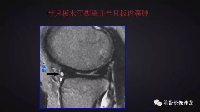 【PPT】膝关节解剖和半月板损伤影像解读