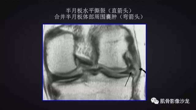 【PPT】膝关节解剖和半月板损伤影像解读