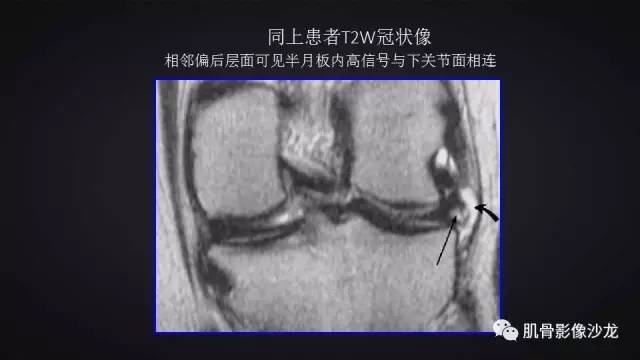 【PPT】膝关节解剖和半月板损伤影像解读