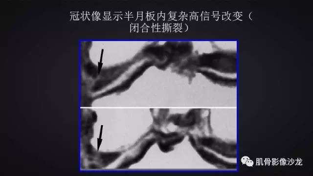 【PPT】膝关节解剖和半月板损伤影像解读