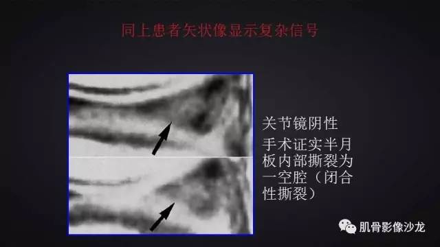 【PPT】膝关节解剖和半月板损伤影像解读