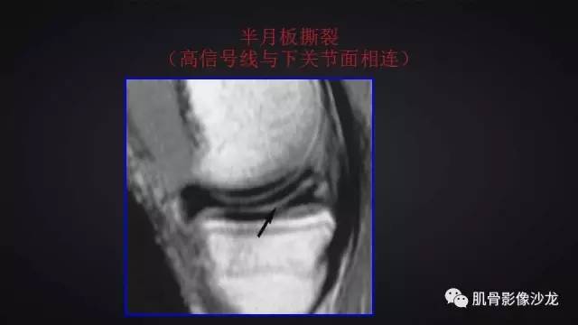 【PPT】膝关节解剖和半月板损伤影像解读