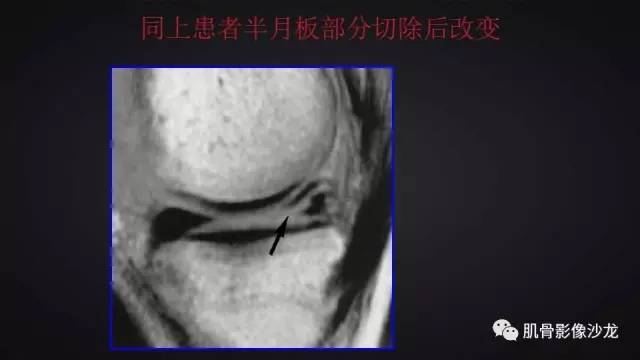 【PPT】膝关节解剖和半月板损伤影像解读