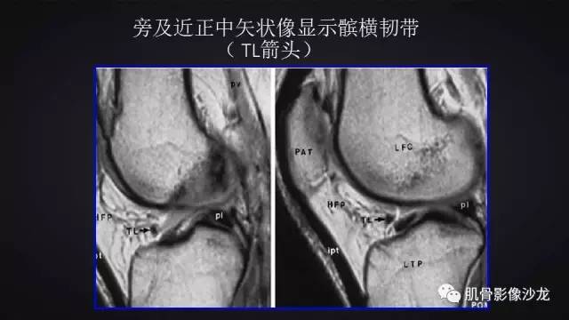 【PPT】膝关节解剖和半月板损伤影像解读