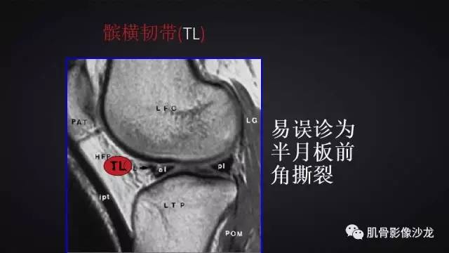【PPT】膝关节解剖和半月板损伤影像解读