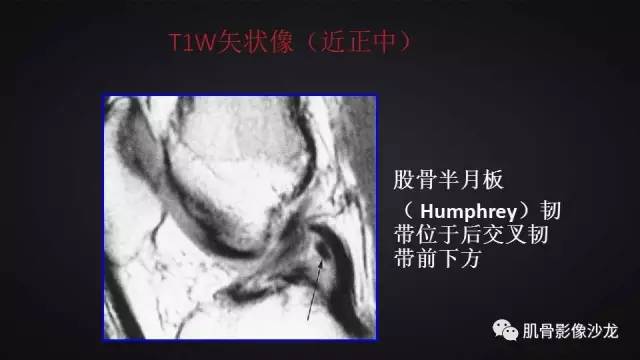【PPT】膝关节解剖和半月板损伤影像解读