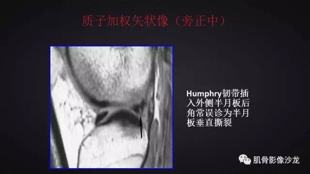 【PPT】膝关节解剖和半月板损伤影像解读