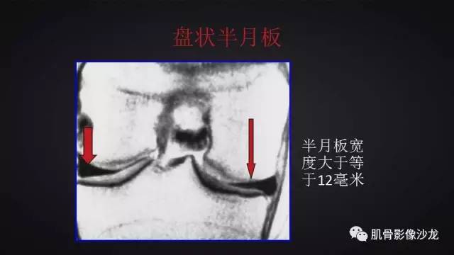 【PPT】膝关节解剖和半月板损伤影像解读