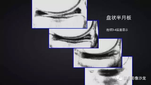 【PPT】膝关节解剖和半月板损伤影像解读