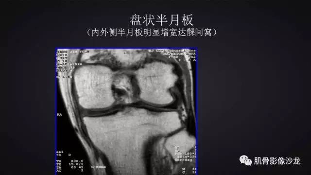 【PPT】膝关节解剖和半月板损伤影像解读