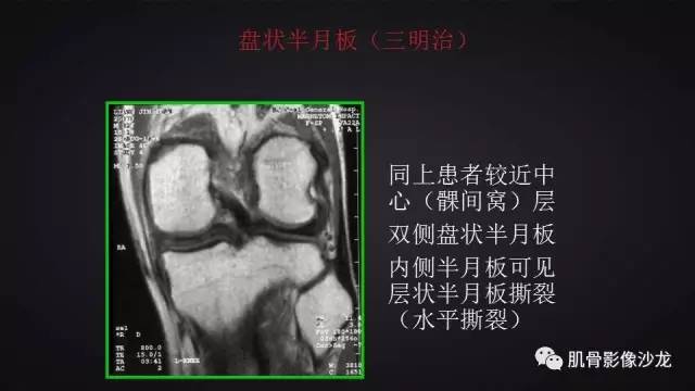 【PPT】膝关节解剖和半月板损伤影像解读