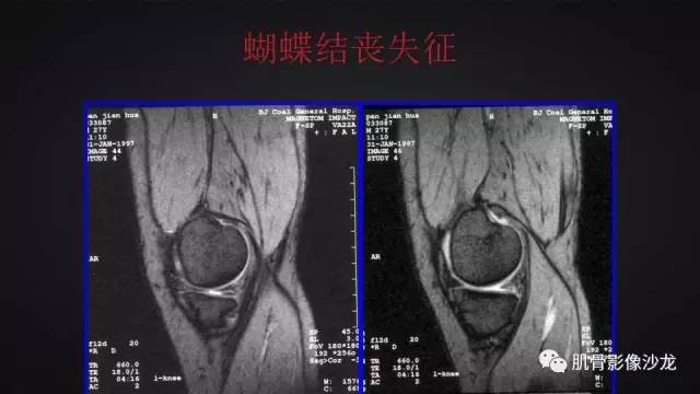 【PPT】膝关节解剖和半月板损伤影像解读