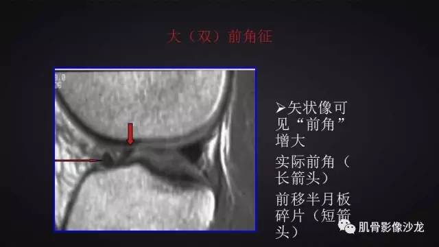 【PPT】膝关节解剖和半月板损伤影像解读